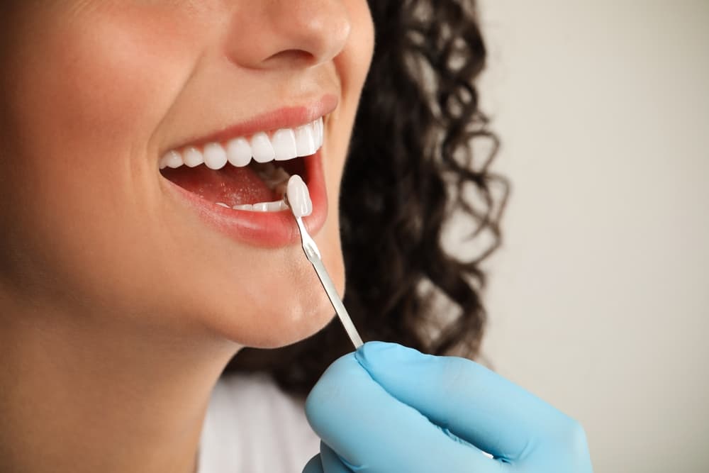 Veneers