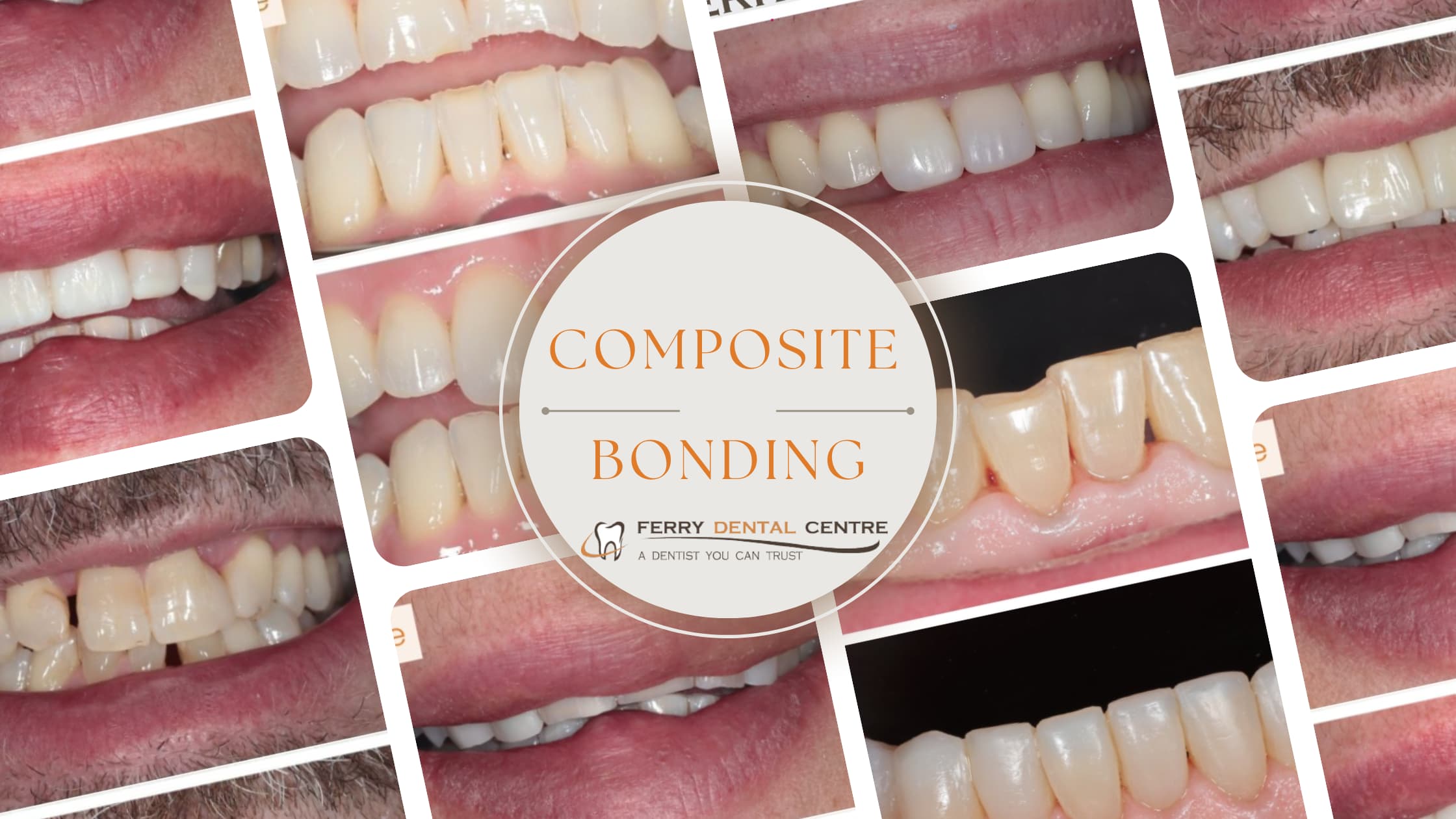 Ferry Dental Composite Bonding