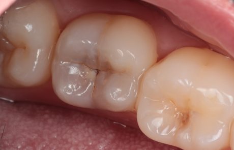 A Small Black Spot Can Hide a Big Cavity