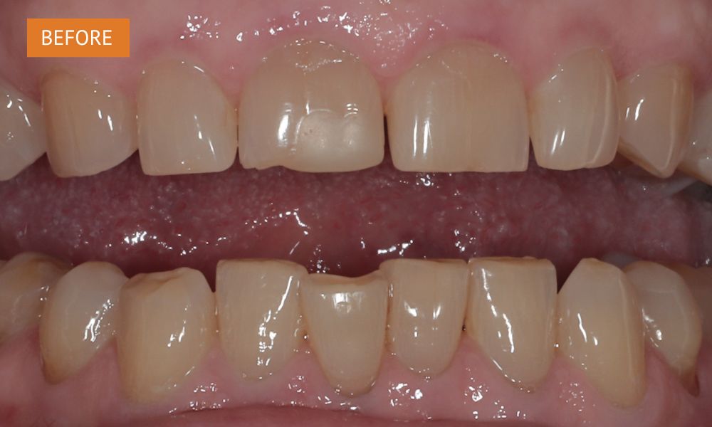 a photo of teeth before smile makeover using composite bonding