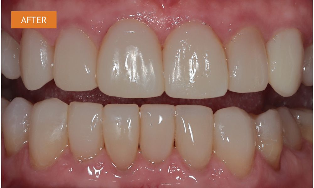 a photo after smile makeover using composite bonding