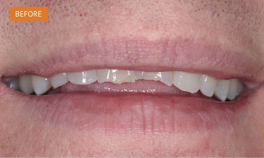 before composite bonding for heavily worn front teeth