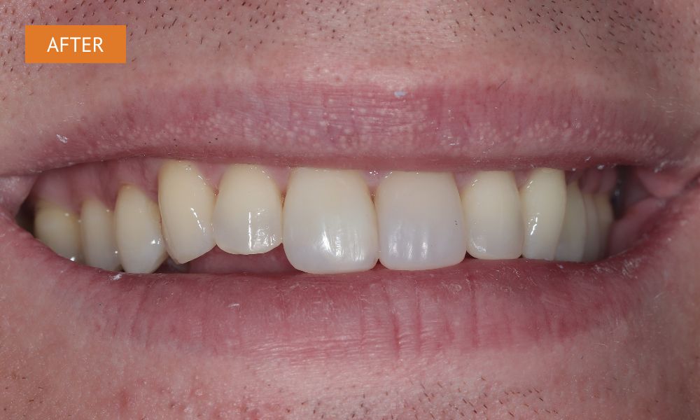 after composite bonding to restore natural teeth shape