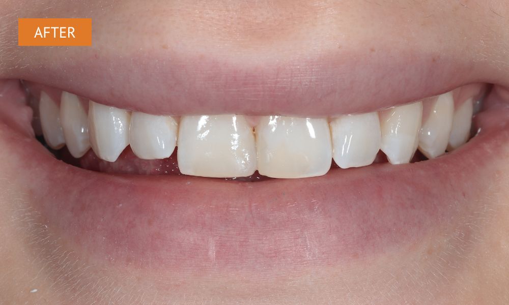 a photo after repairing a chipped tooth with composite bonding in Southampton