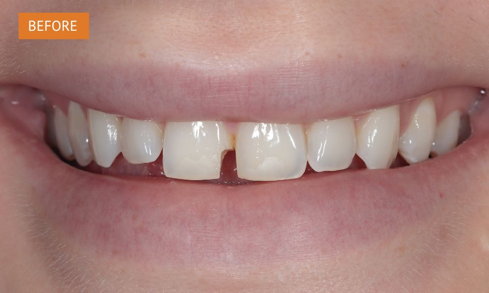 a photo before repairing a chipped tooth with composite bonding