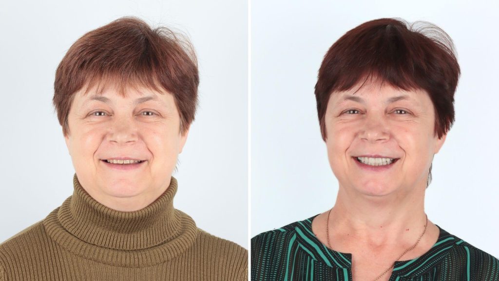 Composite Bonding Southampton Before and After