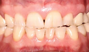 Severely worn and shortened showing enamel loss caused by long-term teeth grinding (bruxism)