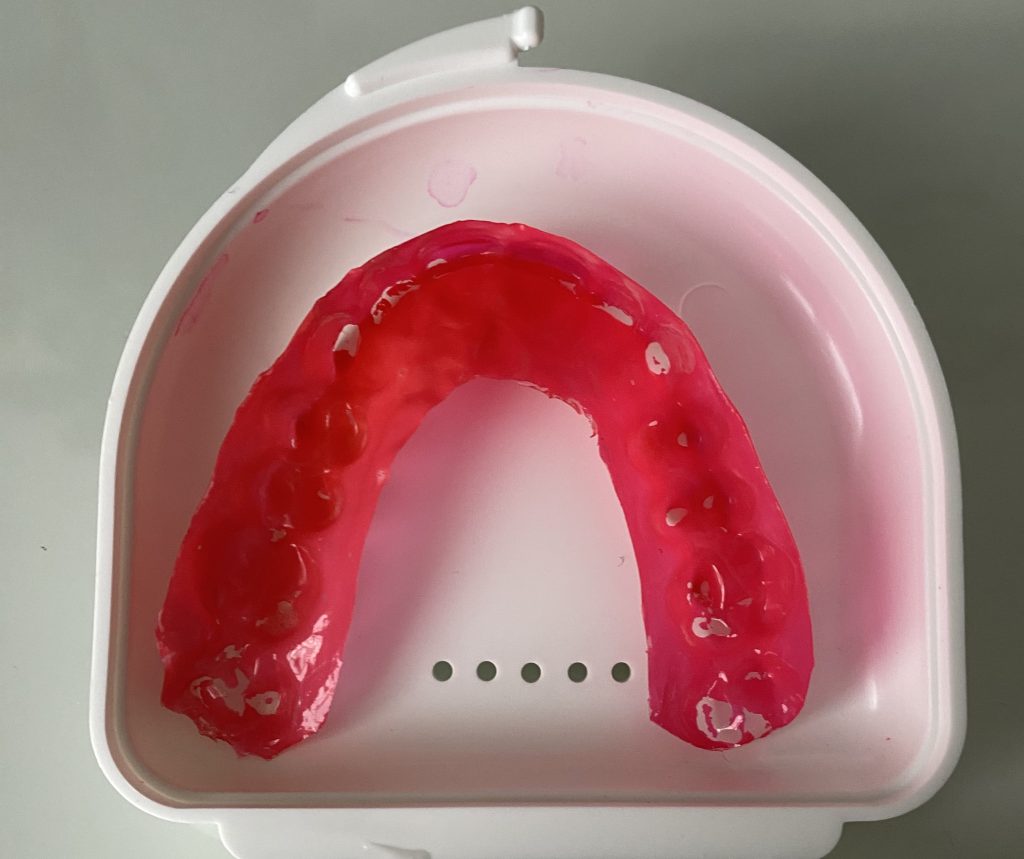 Brux Checker appliance after use showing visible contact points and wear patterns indicating areas of teeth grinding and clenching during sleep.