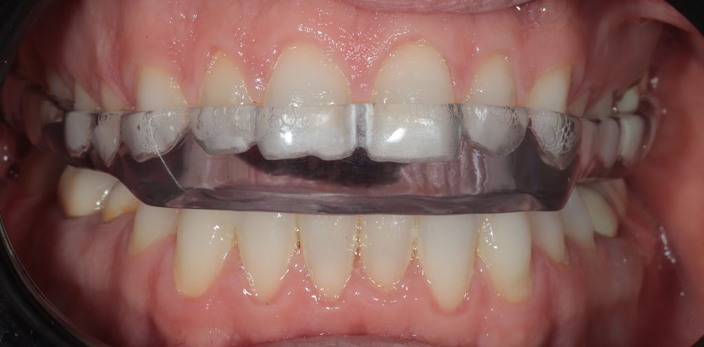 Clear upper dental night splint fitted over upper teeth to protect against bruxism and reduce tooth grinding during sleep.