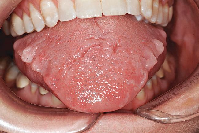 Scalloped tongue with visible indentations along the edges, commonly associated with teeth grinding or clenching during sleep (bruxism).