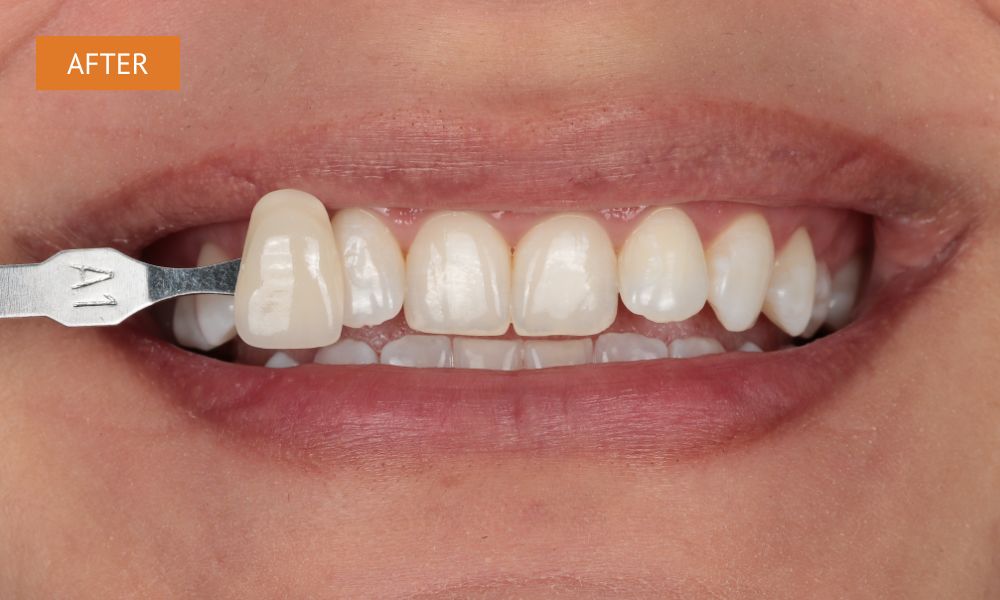 Teeth whitening after treatment – natural-looking brighter smile result