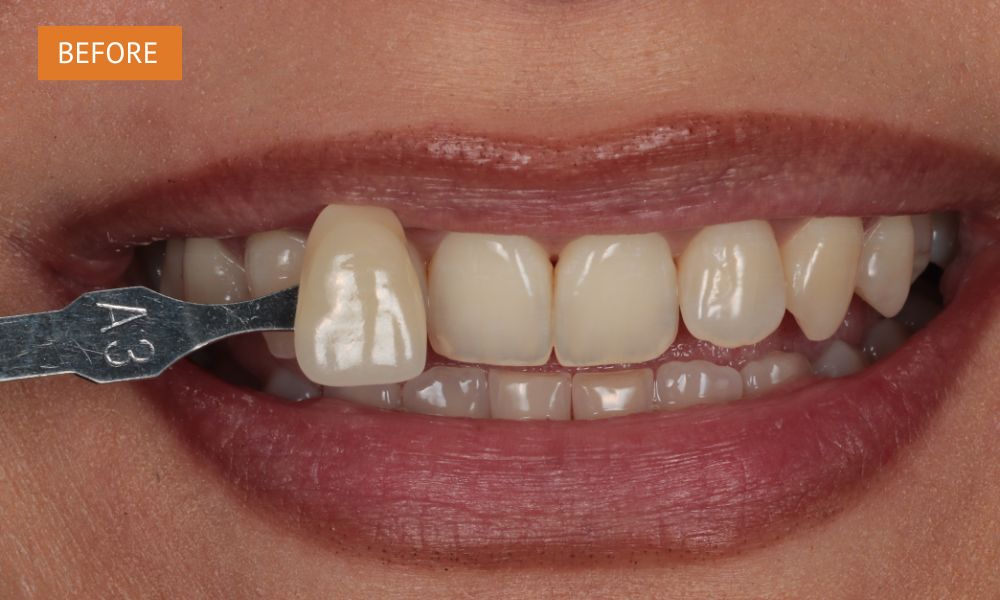 Teeth whitening before treatment – natural tooth shade prior to whitening