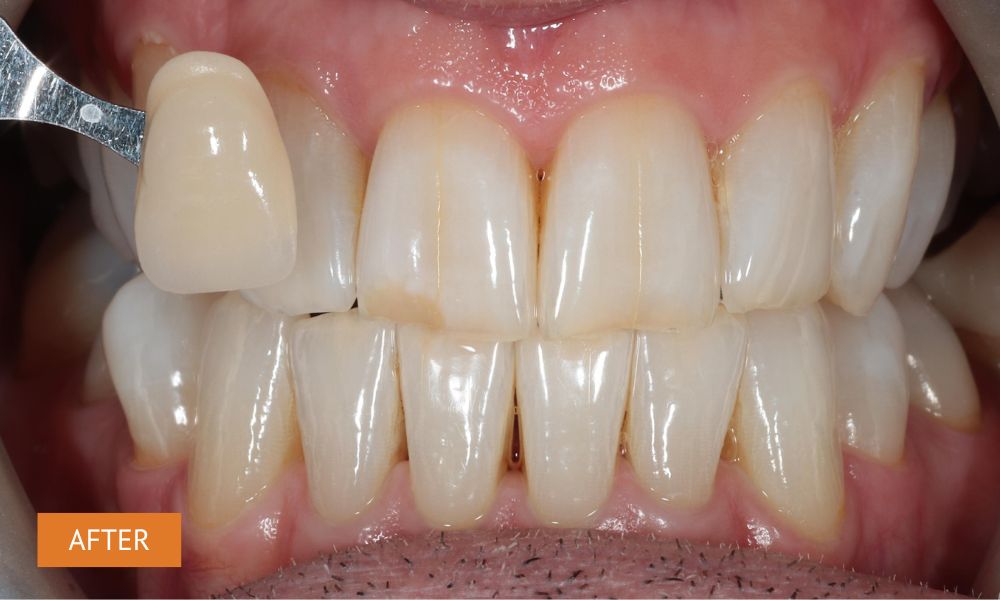 Teeth whitening after results – improved smile brightness with custom whitening trays