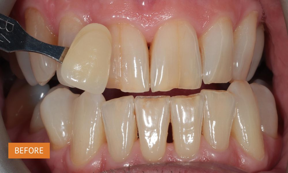 Teeth whitening before treatment – initial tooth shade prior to at-home whitening