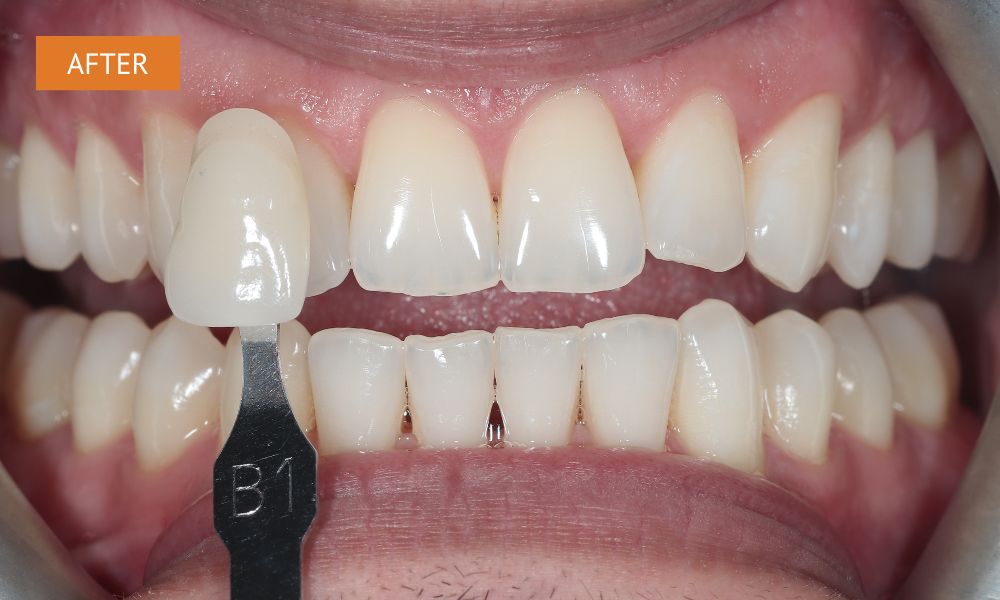Teeth whitening after treatment – even, natural whitening result with custom trays