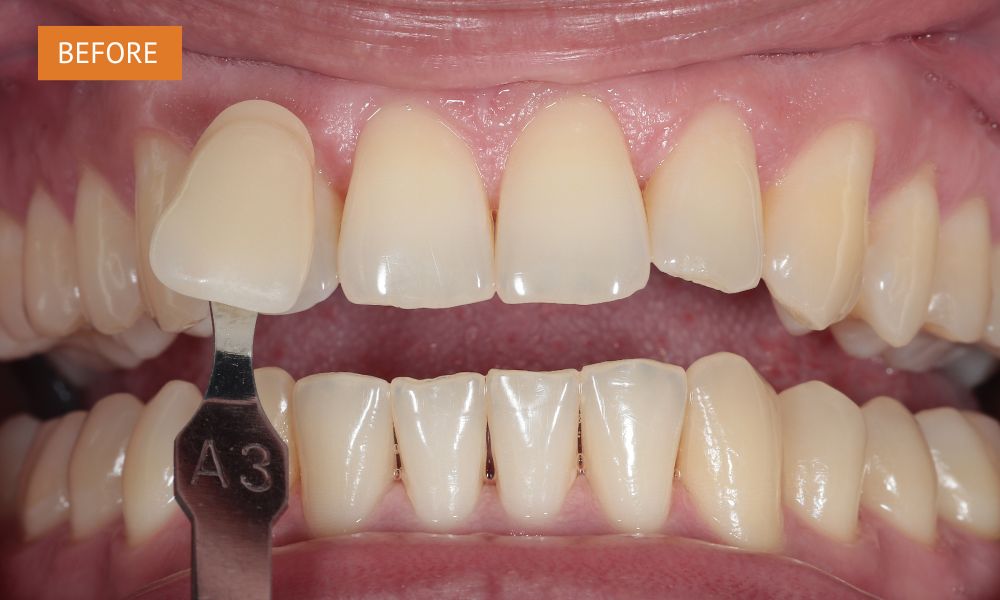 Teeth whitening before treatment – darker natural tooth shade prior to whitening